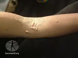 Multicentric reticulohistiocytosis