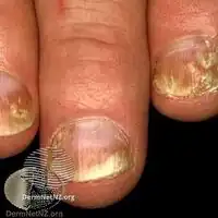 Nail psoriasis