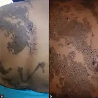 Nevus comedonicus: clusters and Blaschkoid distribution