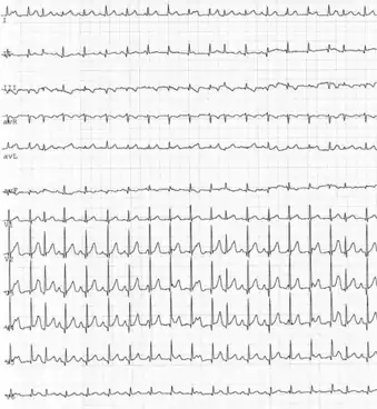 Junctional ectopic tachycardia