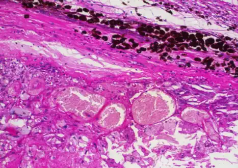 Coats' disease: histopathological findings, telangiectasic retinal vessels