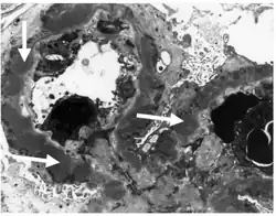 Subepithelial dense deposits and basement membrane reaction arrows