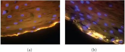 a,b) Gardnerella vaginalis biofilm  is detected at the edge of the vaginal epithelium