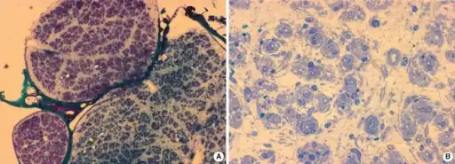 a) Profound loss of myelinated fibers in one fascicle b) marked nerve fiber hypertrophy
