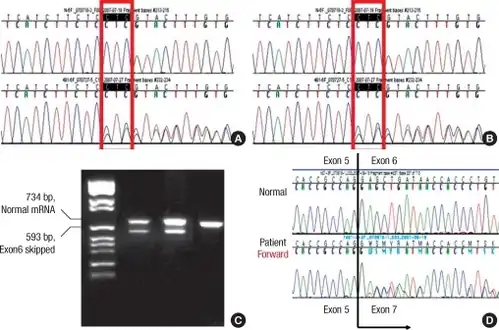 Heterozygous mutations in the KCNQ1 gene- a) Genomic DNA sequencing indicates c.828_830delCTC, p.S277del, heterozygote b) c.921G>A, p.V307V, heterozygote c) PCR detects abnormally spliced mRNA product, exon 6 had been skipped  d)PCR products confirms exon 6 skipping due to mutation
