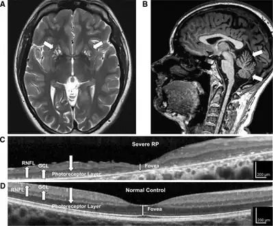 a-d)High-resolution retinal and brain imaging in NARP syndrome demonstrates analogous patterns of tissue injury
