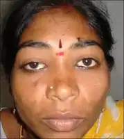 Right eye partial ptosis