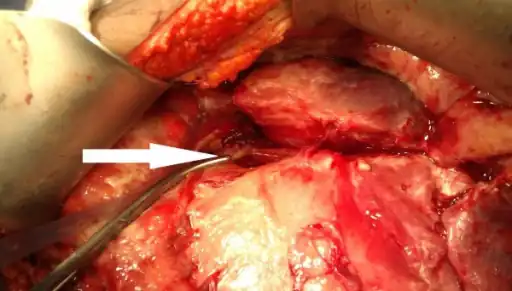 Pancreatic pseudocyst can be seen pushing the stomach and duodenum anteriorly at  time of surgery