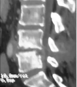 Discitis with anterior abscess (and disc space abscesses)