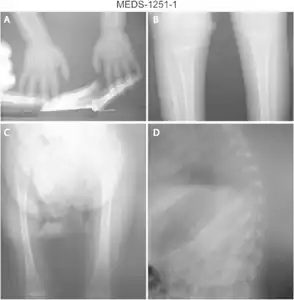 a) Osteopenia in carpal, metacarpal and phalanges b) tibia and fibula with metaphyseal widening/osteopenia c)severe osteopenia d) osteopenic ribs.