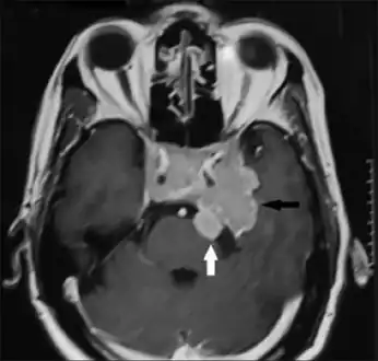 Invasive  prolactinoma showing invasion into the left temporal lobe