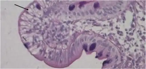 Duodenal biopsy from  ABL individual shows  vacuolated enterocytes