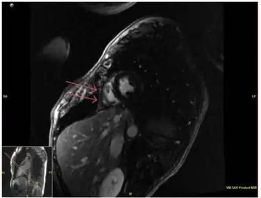 Pericardial enhancement of  right ventricular free wall on cardiac MRI consistent with acute pericarditis.