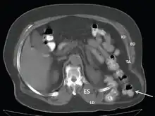 CT scan-Grynfeltt-Lesshaft hernia.