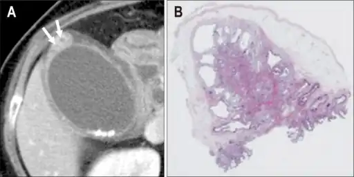 Individual with adenomyomatosis a) Axial computed tomography image b) photomicrograph