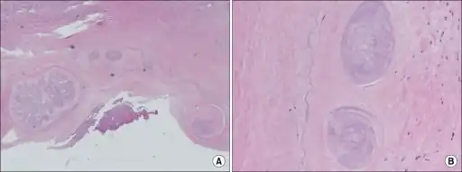 Trichinella spiralis are seen in the fibromuscular tissue of the right ventricle