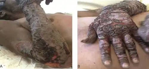 a)Pellagra on the extensor surface of  forearm b) dorsa of his hand