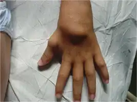 Exuberant ‘boggy’ synovitis of wrist in a child with Blau syndrome.