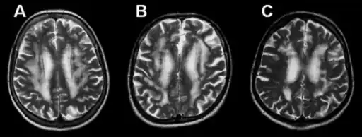 MRI-a-c)Three  brains with the pure  pathology of Binswanger's disease