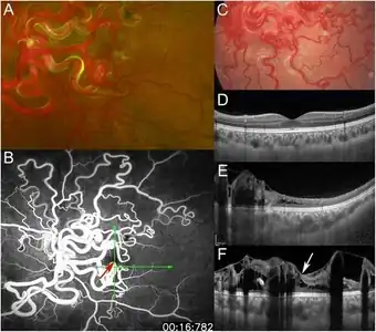 a) Retinal arteriovenous malformations b) direct arteriovenous communication, fovea red arrow  c)less dilated and tortuous  d)healthy eye e,f) demonstrate retinal edema with cystic changes