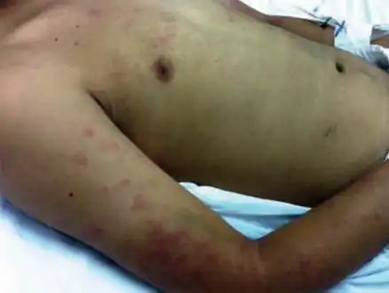 Maculopapular exanthema and purpura in arms