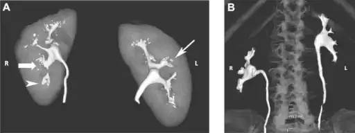 a)Bilateral papillary necrosis b)appearance of a normal papilla