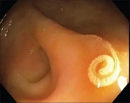 Endoscopic view of Trichuris trichiura in  cecum