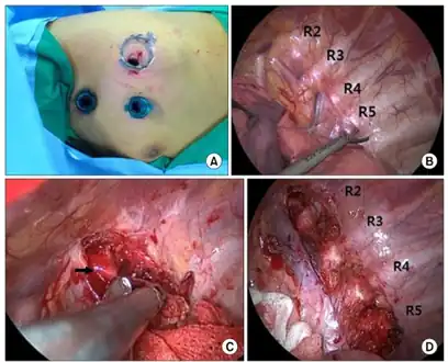 a-d)Intraoperative findings during left cardiac sympathetic denervation in a person with catecholaminergic polymorphic ventricular tachycardia