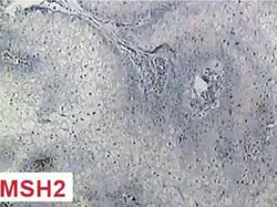 Sebaceous adenoma reveals nuclear negativity for repair enzyme MSH2