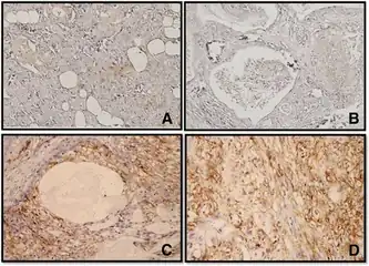 a-d)Immunohistochemistry for CD44 in Mucoepidermoid carcinomas