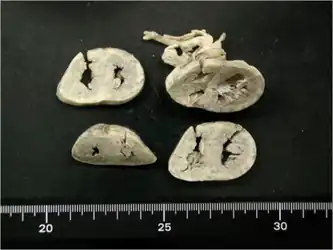 Heart of the 6-day-old GAII person with a causative novel ETFB mutation showing a thickened ventricle wall and narrow ventricular lumen.