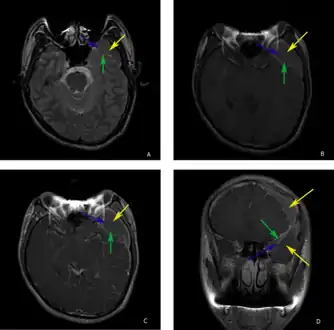 a-d)individual with complicated arachnoid cyst