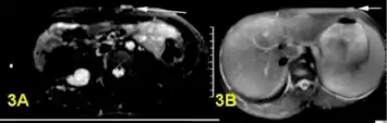 a,b)Bright plexiform neurofibroma
