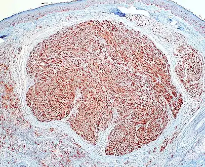 Palisaded and Encapsulated Neuroma