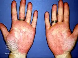 Palmar erythema