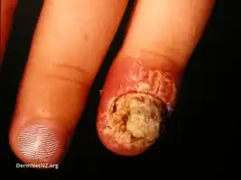 Parakeratosis pustulosa