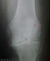Vertical patella fracture