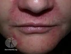 Perioral dermatitis