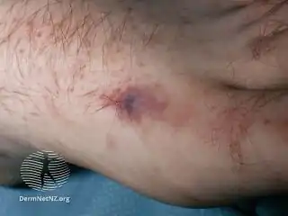 Meningococcal petechiae