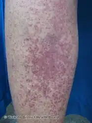 Petechiae