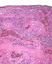 Micrograph of diffuse TGCT showing pigmented hemosiderin-laden macrophages (brown/red).