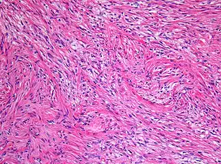 Histopathology of pilocytic astrocytoma (grade I WHO).