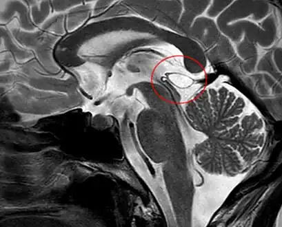 Another case: sagittal