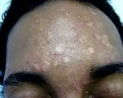 Pityriasis versicolor: light appearance in a person with dark skin.