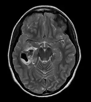PXA as visualized on an MRI
