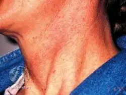 Poikiloderma of Civatte