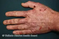 Porphyria cutanea tarda