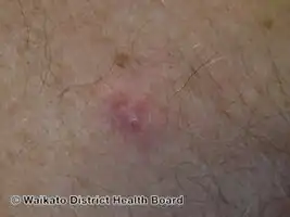 Primary cutaneous adenoid cystic carcinoma