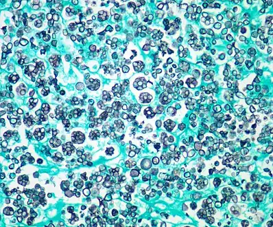 Photomicrograph of Prototheca wickerhamii infection in a human. Note the floret-like arrangements. Gomori methenamine silver(GMS) stain.