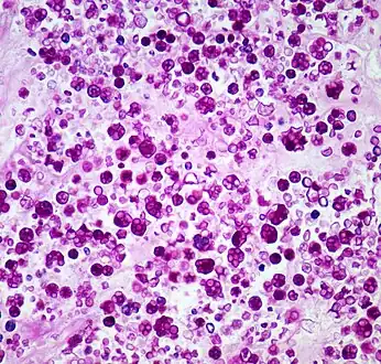 Photomicrograph of Prototheca wickerhamii infection in a human.